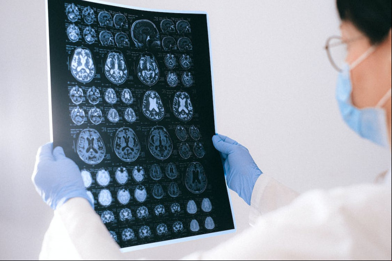 Alzheimer: diagnóstico tardio dificulta tratamento
